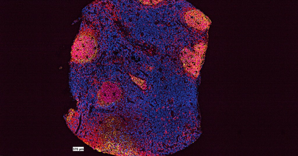 202209 centro germinativo linfonodo
