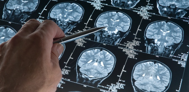 alzheimer