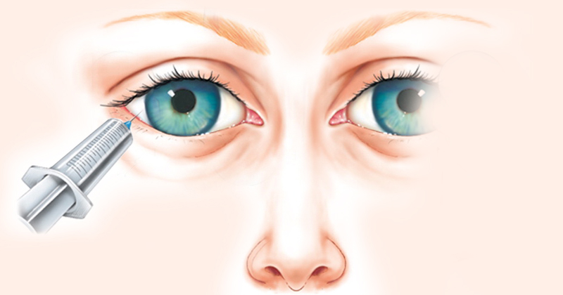 anestesia-ocular2