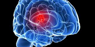 cancercerebral