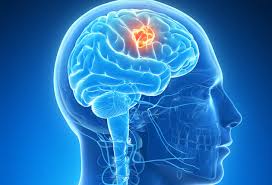 cancercerebro