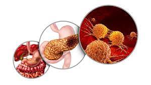 cancerpancreas