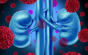 cancerrenal