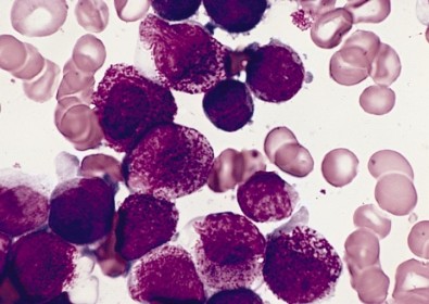 celulatumoral