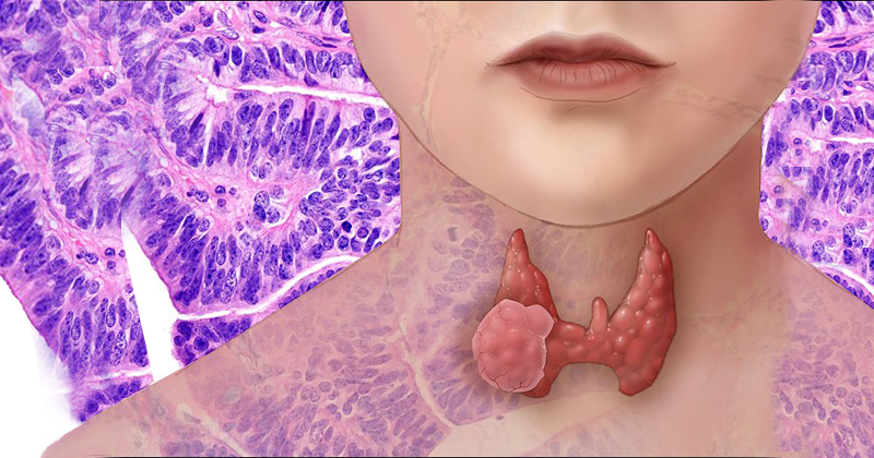 dna tumor 