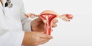 endometriose