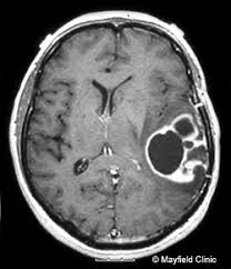 glioma