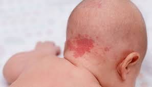 hemangiomas
