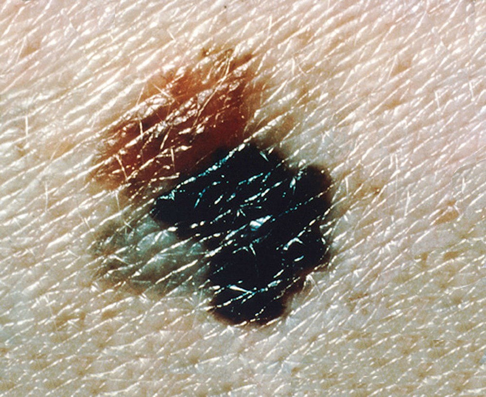 melanoma1
