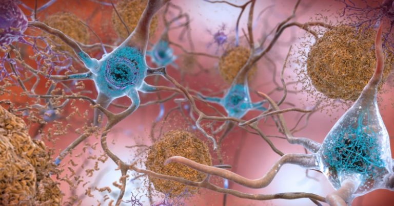 neuronio alzheimer1 768x403