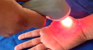 fibromialgia