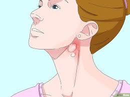 linfoma