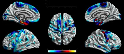 neuroimagem