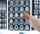 A morfologia cerebral do TOC: estudo inédito aponta mecanismos do cérebro ligados à origem da doença